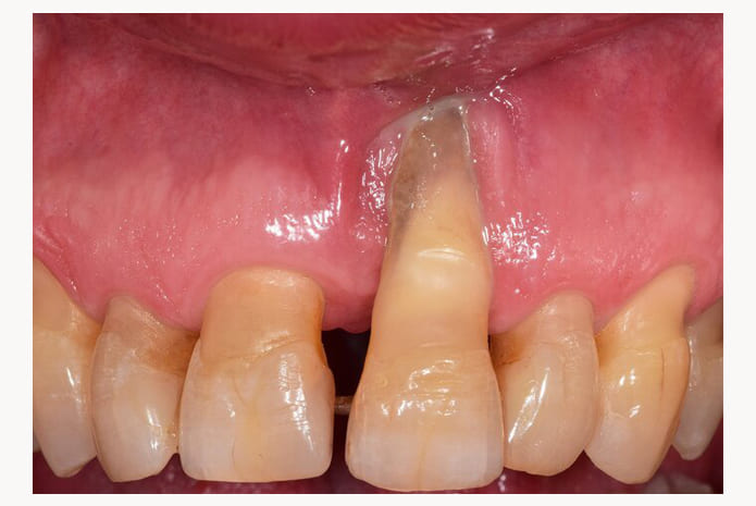 Regeneraci N Alveolar Vertical Y Horizontal En El Sector Anterior