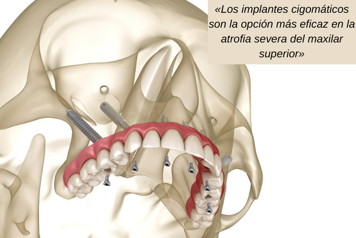 Una puesta al día en implantes cigomáticos Gaceta Dental