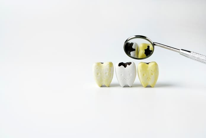 Caries dental y otras condiciones que también tienen como resultado la pérdida de minerales de los dientes.