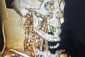 El Servicio de Cirugía Maxilofacial de Albacete realiza una novedosa reconstrucción mandibular mediante colgajo microvascularizado de cresta ilíaca