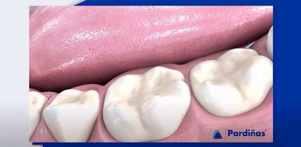 Recreación en 3D donde se puede observar la pérdida de estructura dental debida al contacto de los dientes con elementos abrasivos