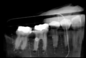 Así se ve la rejilla en una exploración de la mandíbula de un paciente.