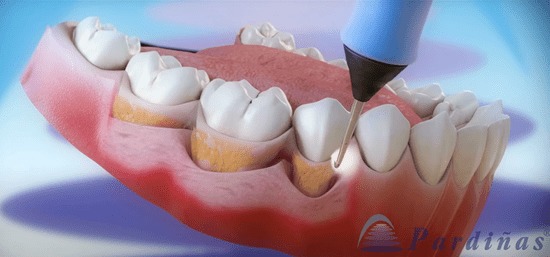 Imagen 3D en la que se muestra un momento de la limpieza dental, en el que se está eliminando el sarro acumulado en la encía.