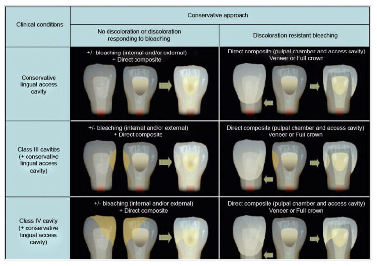 Actualización en la reconstrucción del diente endodonciado
