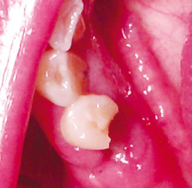 Complicaciones en las extracciones de terceros molares: alveolitis seca