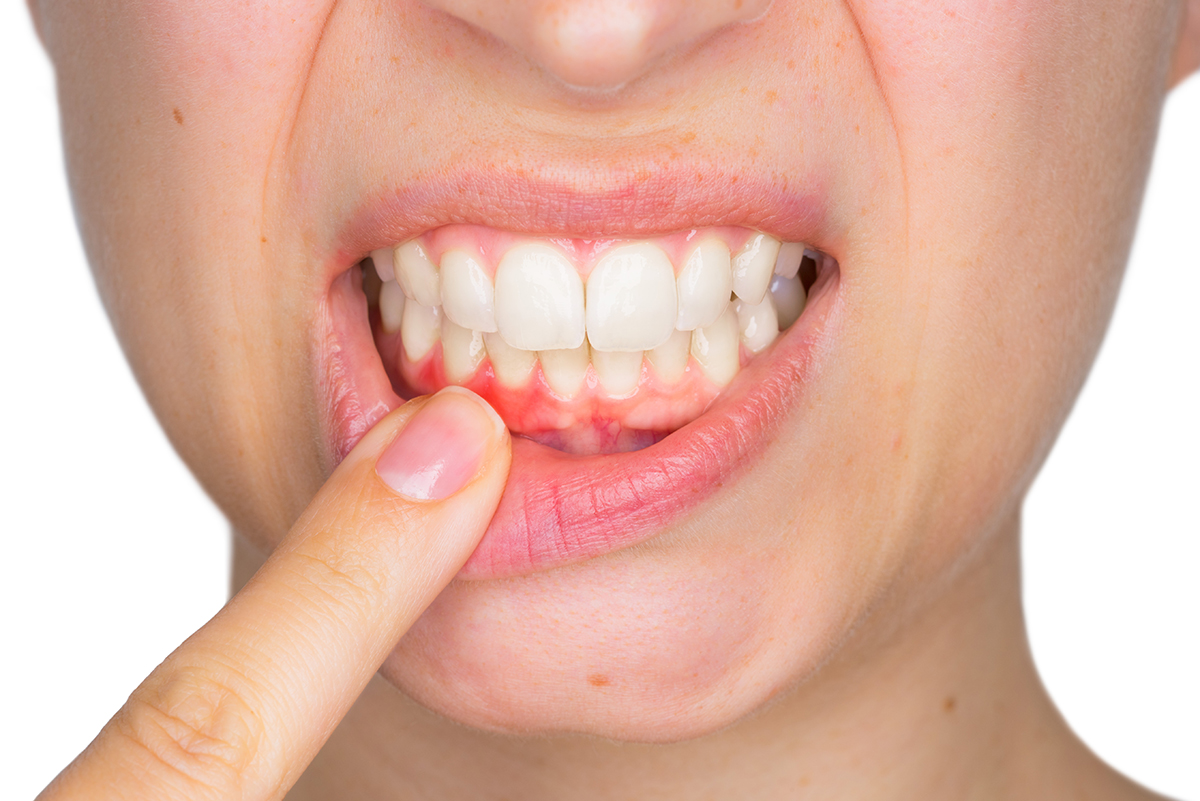 Excluir vestido Por lo tanto Un nuevo estudio relaciona el sangrado de las encías con la falta de  vitamina C - Gaceta Dental