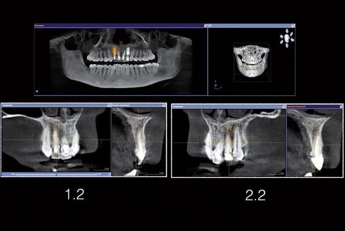 Figura 6. Imagen del CBCT con la planificación de implantes en 1.2 y 2.2 , ambos de 3,8x11,5 mm