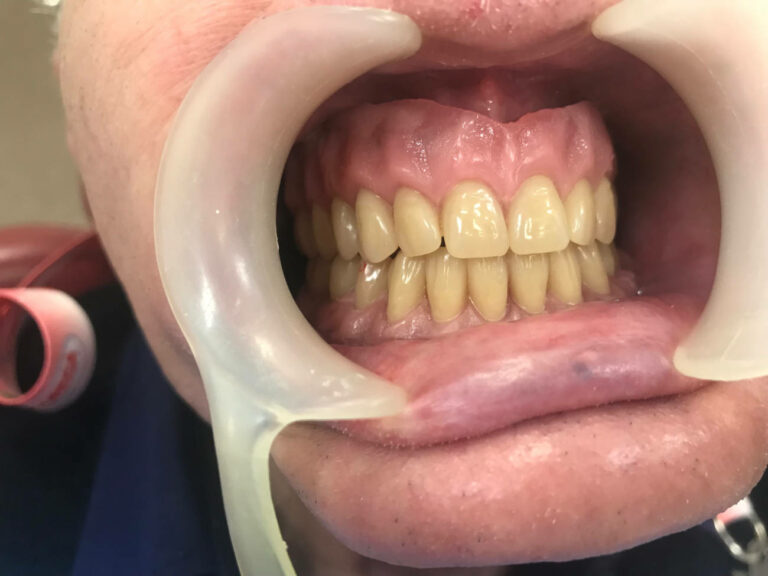 Rehabilitación dental implantosoportada sobre hueso peroné: el reto son las partes blandas