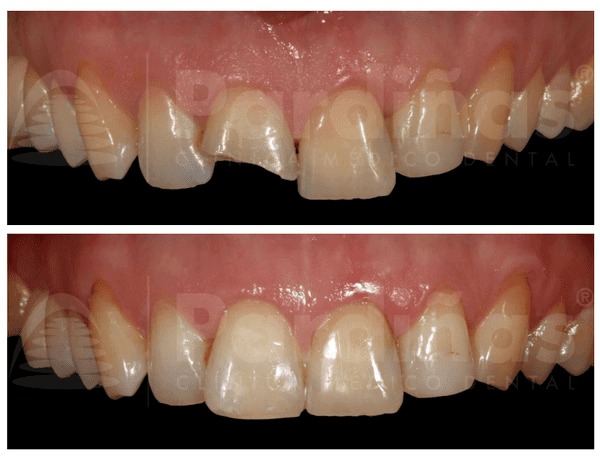 El antes y después tras una restauración o reconstrucción dental