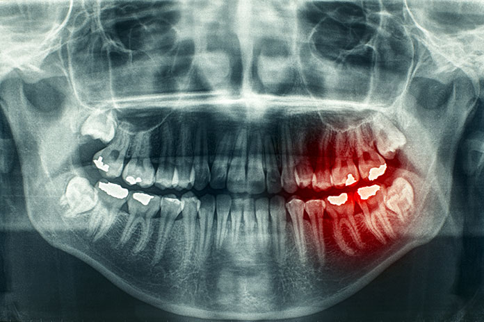 El 90% de los casos de cáncer oral y orofaríngeo se podrían curar con un diagnóstico precoz