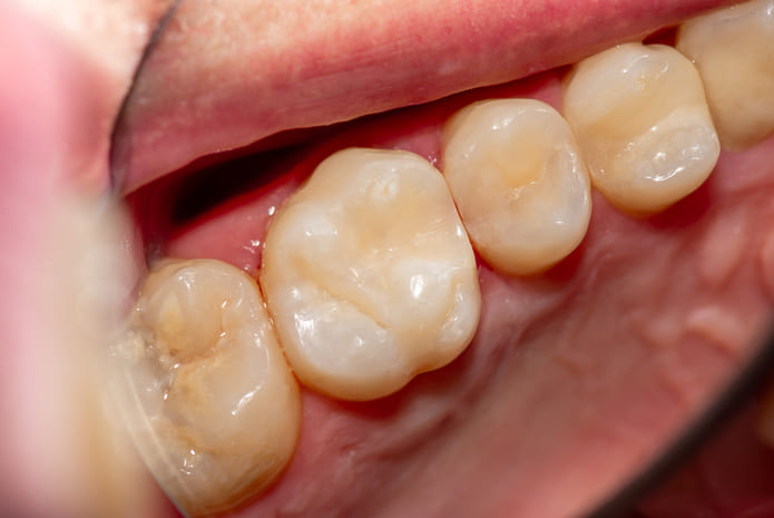 Un compuesto derivado del mejillón mejora la durabilidad del tratamiento de obturación dental