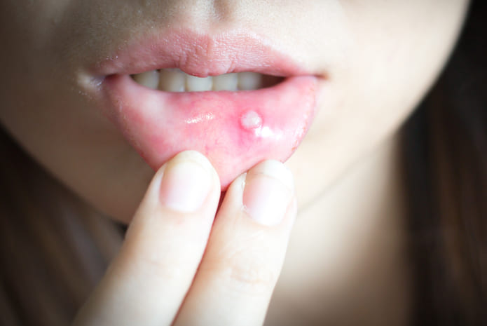 Un grupo de expertos consensúa unas pautas para el diagnóstico de úlceras orales complicadas.