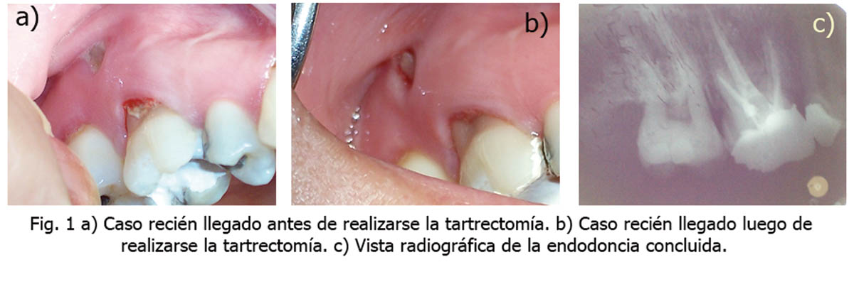 Tratamiento Integral De Lesión Endoperiodontal En Molar Con Dehiscencia ósea Gaceta Dental 5359