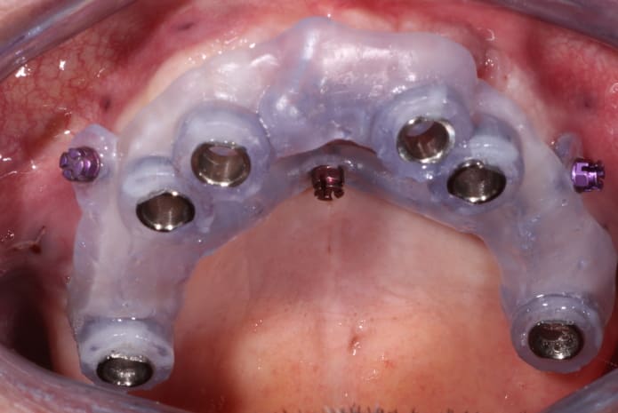 Figura 3. Férula quirúrgica anclada con microtornillos de Ortodoncia.
