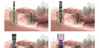 Figura 8. Secuencia de fresado con la guía quirúrgica en posición para la inserción de dos implantes. Podemos observar cómo la secuencia de fresado se adapta a la morfología del implante a colocar en cada una de las dos ocasiones