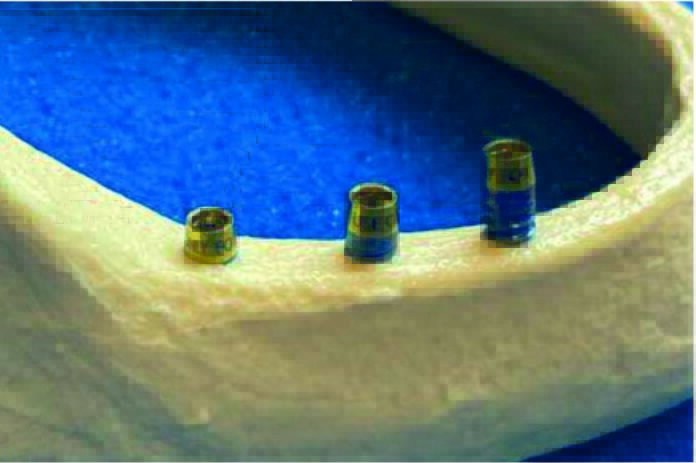Monitorización de la estabilidad de los implantes mediante dispositivo RFA