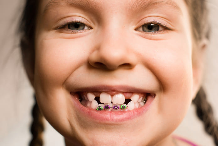 ¿A qué edad hay que poner ortodoncia?