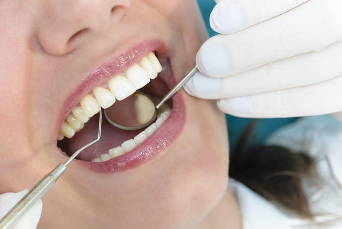 ¿Qué es el curetaje dental o raspado radicular?