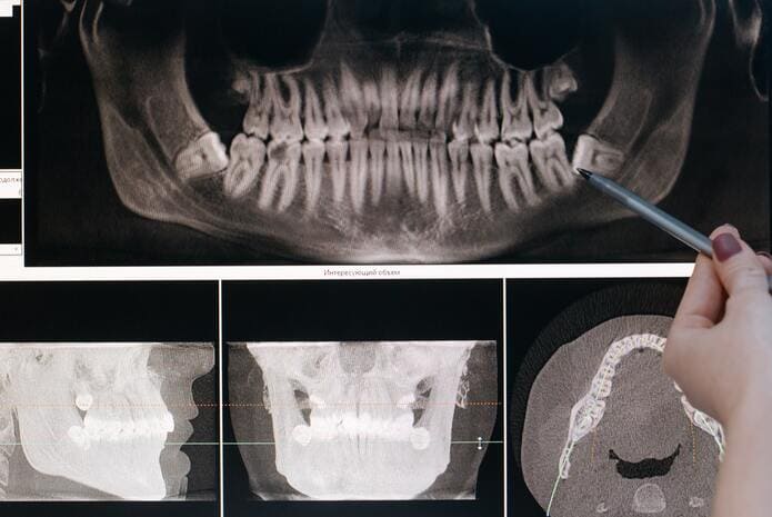 Gracias a las radiografías dentales de dos pacientes se detecta un angiofibroma juvenil asintomático