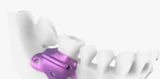 Regeneración periodontal con barrera oclusiva periodontal