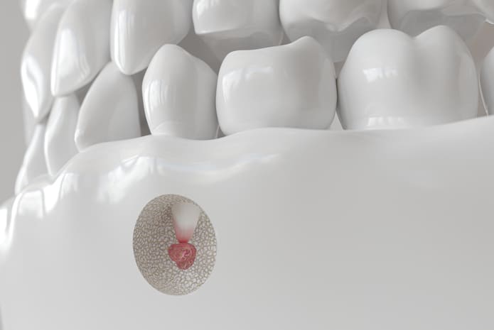 Una nueva patente para mejorar la precisión de las cirugías de endodoncia