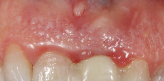Reversibilidad en los tratamientos de Implantología oral