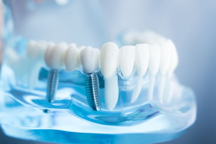 Cómo la tecnología robótica está revolucionando la cirugía tradicional de implantes dentales