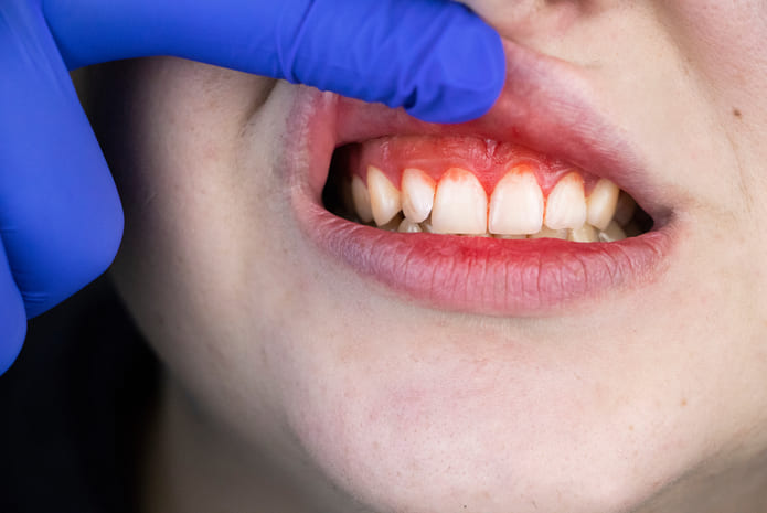 La variación en la inflamación gingival puede llevar a una Odontología más individualizada.