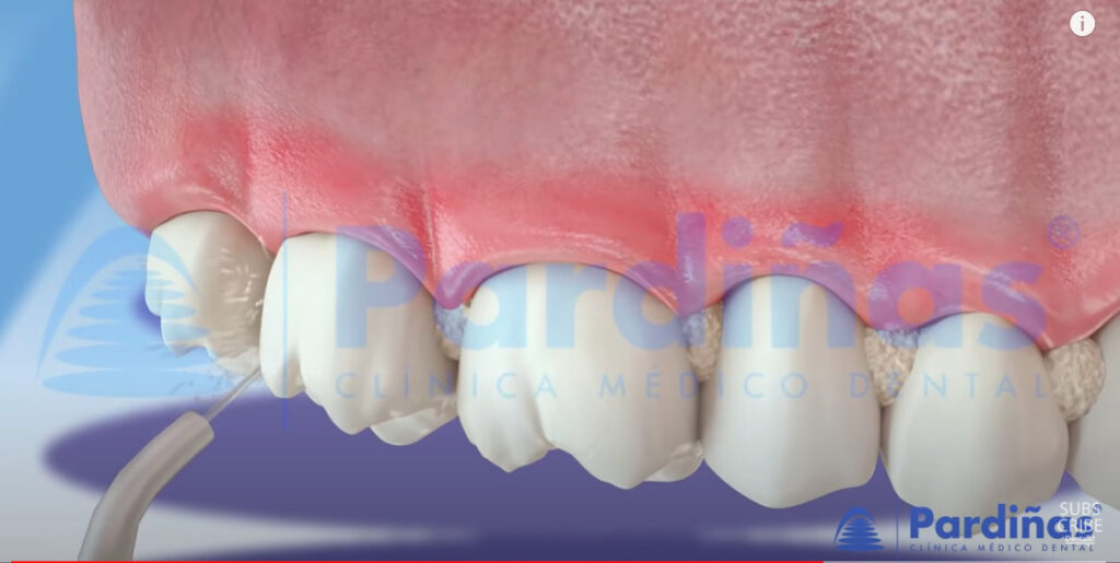 ¿Cuándo y cómo usar el irrigador dental? – Clínica Dental Barrigón
