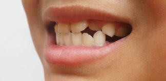 ¿Qué son los dientes supernumerarios y qué significa tener hiperodoncia?