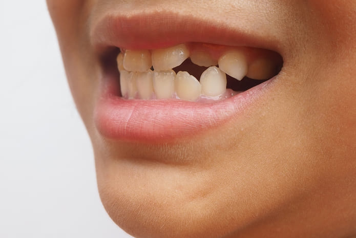 ¿Qué son los dientes supernumerarios y qué significa tener hiperodoncia?