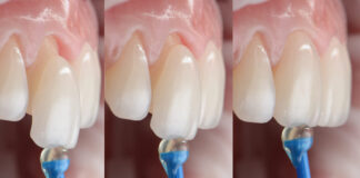 Las carillas dentales y su uso en los tratamientos estéticos.