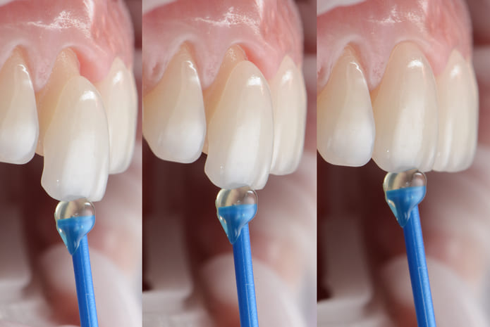 Las carillas dentales y su uso en los tratamientos estéticos.