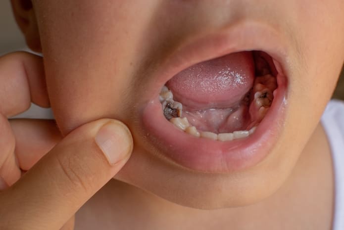 Guía de mejores prácticas clínicas para el tratamiento de lesiones cariosas profundas en dientes primarios