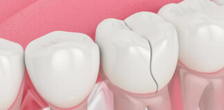 El Síndrome del diente fisurado es uno de los ejemplos de fisuras en los dientes.