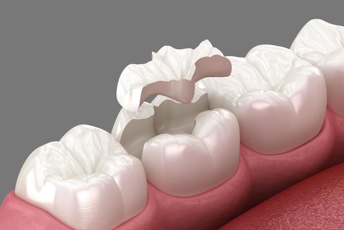 Cuándo y por qué se usan las incrustaciones dentales