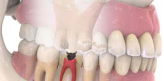 Todo lo que necesitas saber sobre la pulpitis dental.
