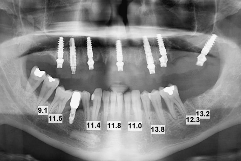 La arcada completa digital en paciente con dientes remanentes