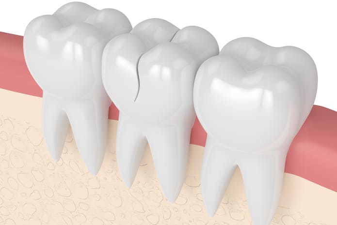 Estudio sobre los dientes agrietados, sus características clínicas y tratamiento