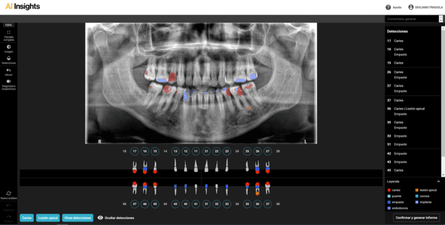 Análisis diagnóstico automatizado de AI Insights de Carestream Dental.