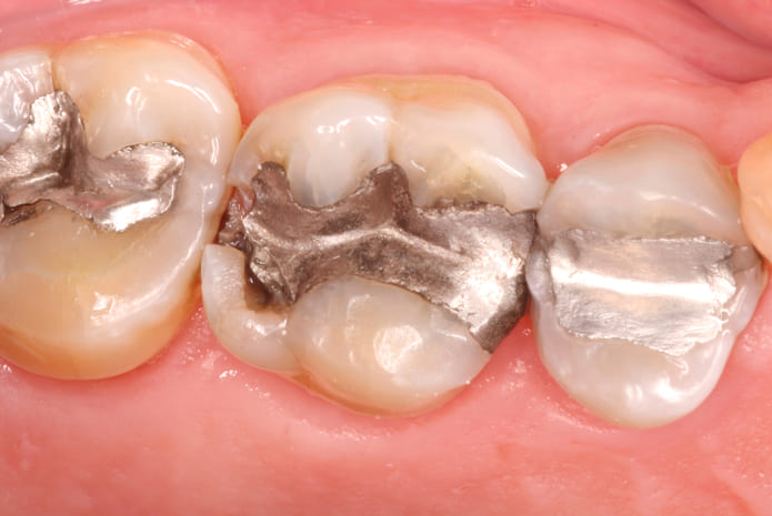 ¿Va a desaparecer realmente la amalgama de los tratamientos dentales?