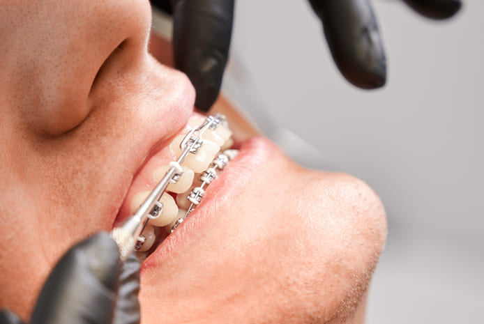 El presente estudio evaluó la eficacia de enmascaramiento y la estabilidad del color de la infiltración de resina de LCI post-ortodoncia después de seis años.