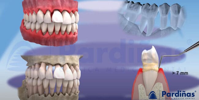 En la periodontitis, ligamento y huesos se ven afectados. 