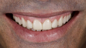 Figura 13. Sonrisa del paciente con los provisionales.