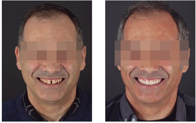Figuras 16 y 17. De izda. a 
dcha.; retrato del paciente 
en sonrisa previo al 
tratamiento; retrato del 
paciente en sonrisa tras el 
tratamiento.