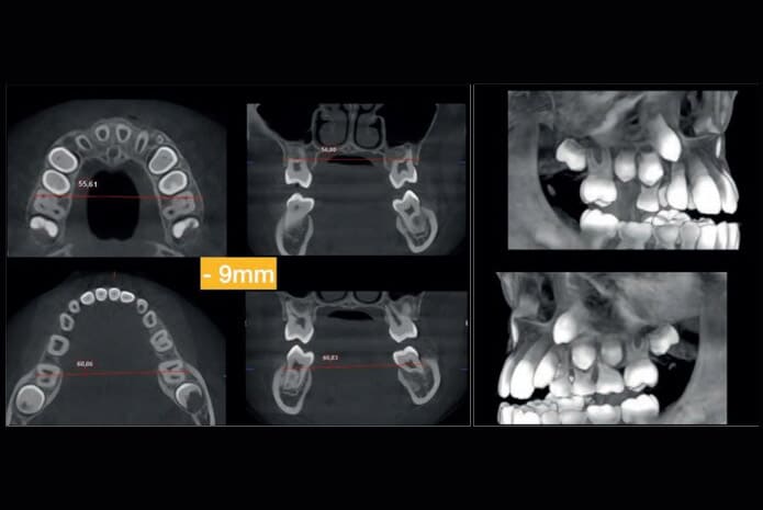 Figura 3. Severa compensación dentoalveolar de los primeros molares inferiores definitivos.
