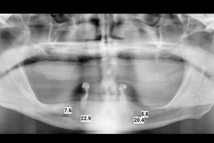 Figura 1. Paciente sin referencias en maxilar superior.