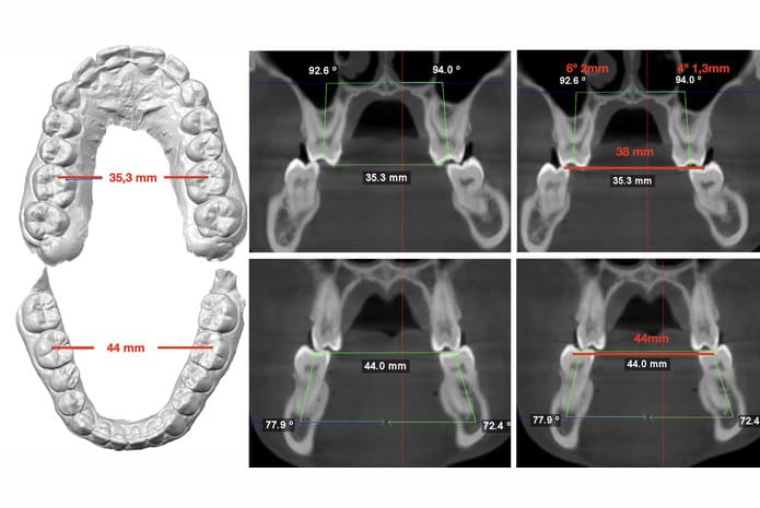 Figura 6 de caso clínico sobre Ortodoncia y cirugía ortognática